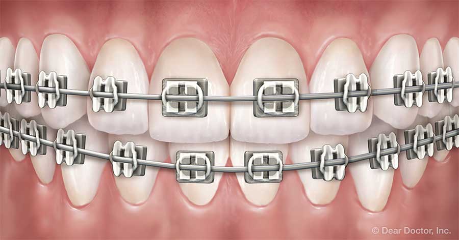 You are currently viewing 箍牙治療的常見不良反應有哪些？